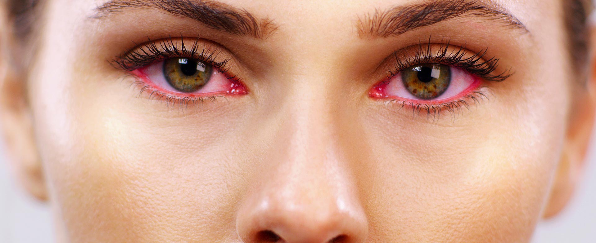 Trockene Augen und Rötungen als Anzeichen des Sicca-Syndroms.